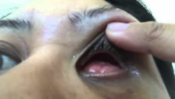 Enucleation - Eyes Alive