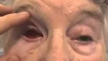 Enucleation - Eyes Alive